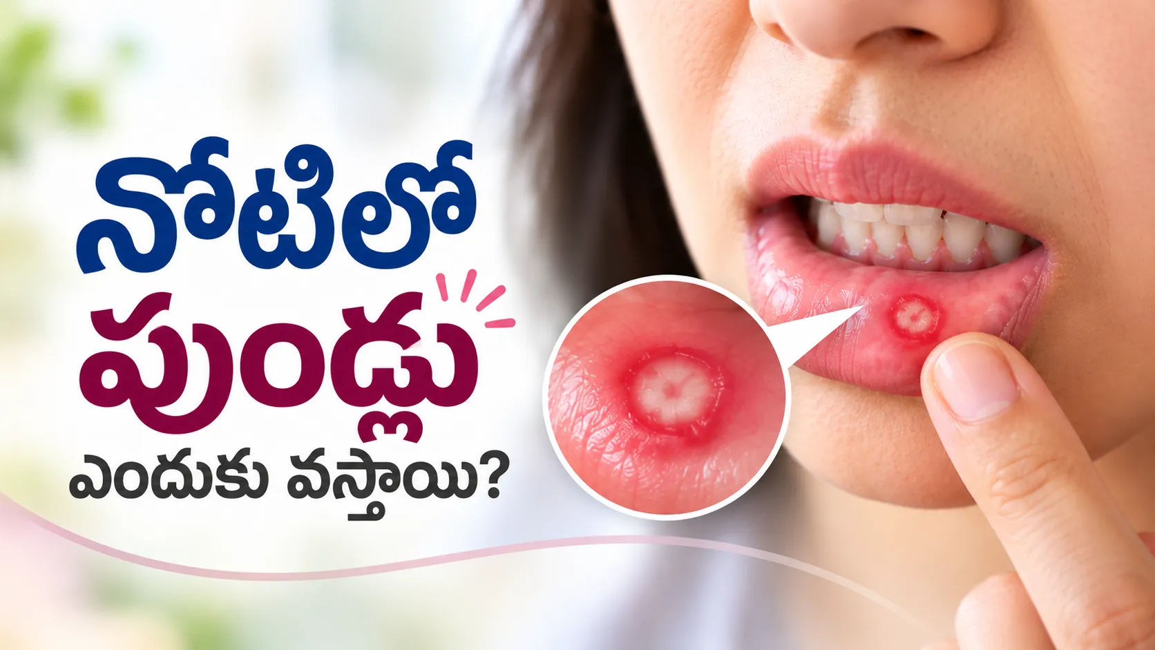 Mouth Ulcers (నోటిలో పుండ్లు): కారణాలు, లక్షణాలు